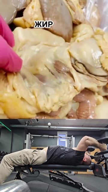 диабет и висцеральный жир