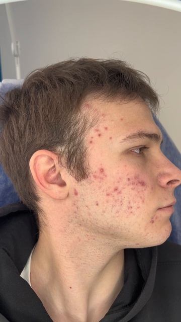 Прыщи, постакне, чёрные точки? Это не «особенность кожи», это задача, которую можно решить.