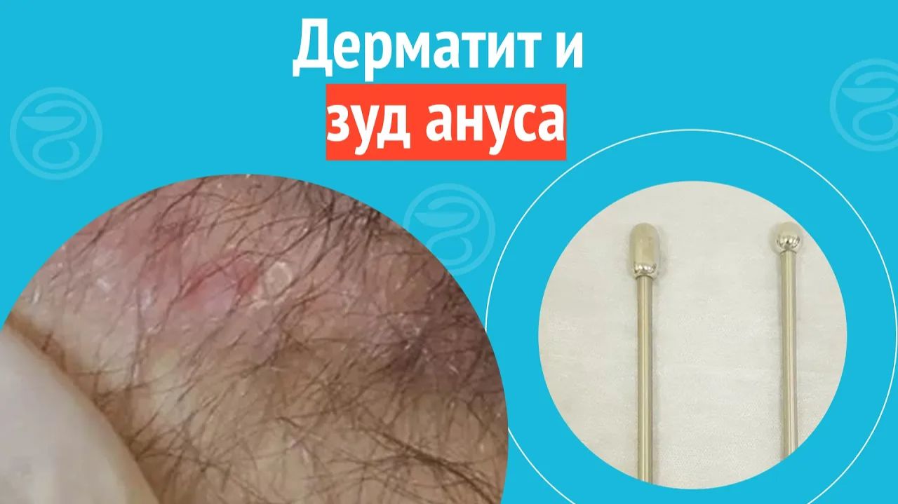 😕 Дерматит и зуд ануса. Клинический случай №1275