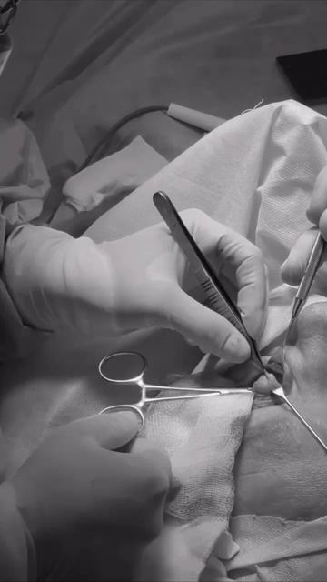 Как проходит круговая блефаропластика?