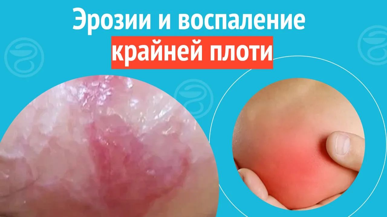 😨 Эрозии и воспаление крайней плоти. Клинический случай №1278