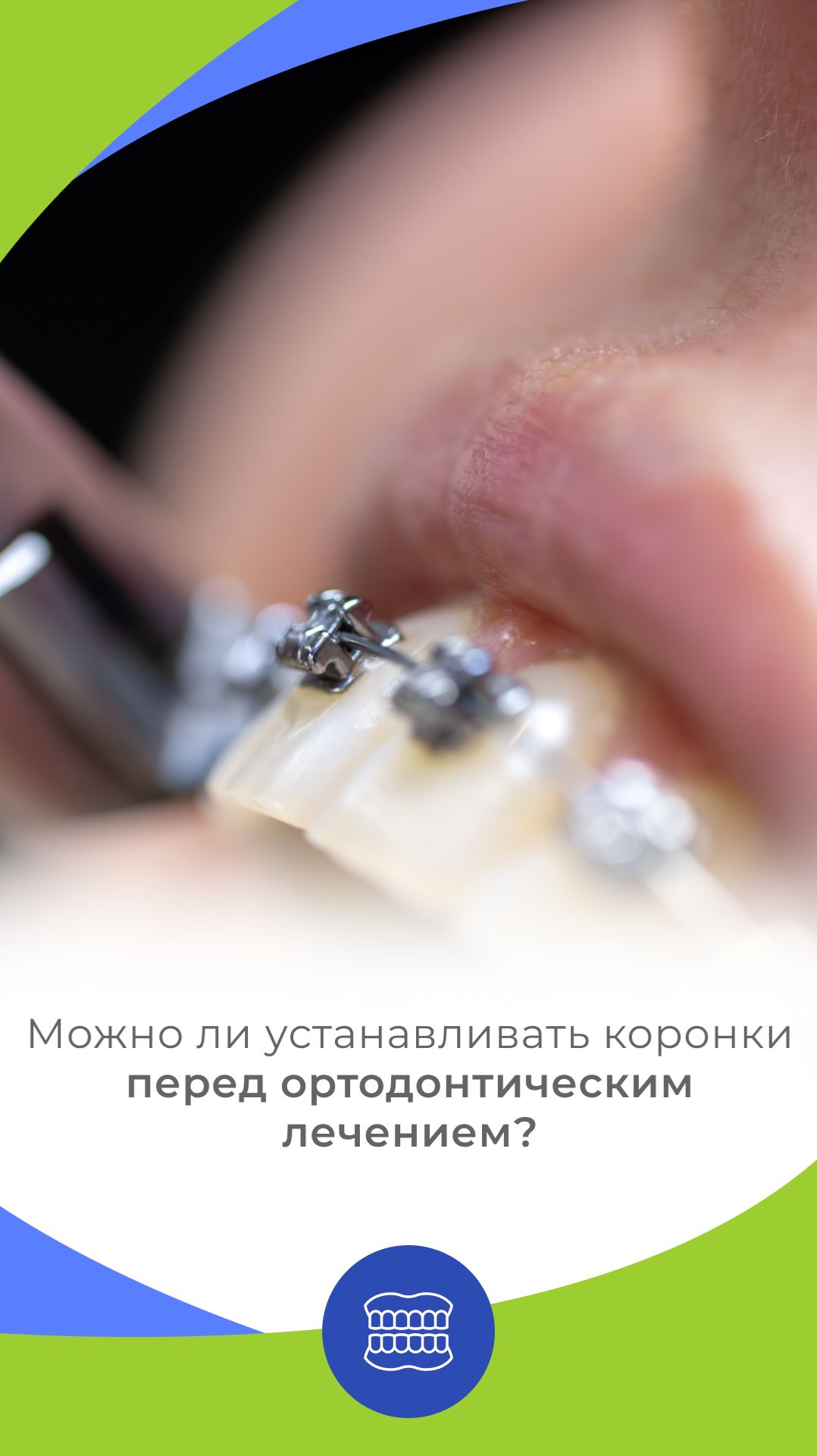 Можно ли устанавливать коронки перед ортодонтическим лечением?