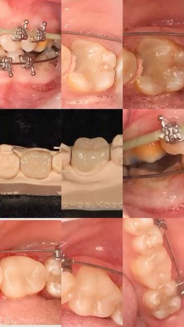 Сохранение зуба при сколе #зуб #стоматология #брекеты #реставрация #эндодонтия #рутуб