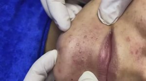 091 • Acne collection • АСМР • Relax Spa