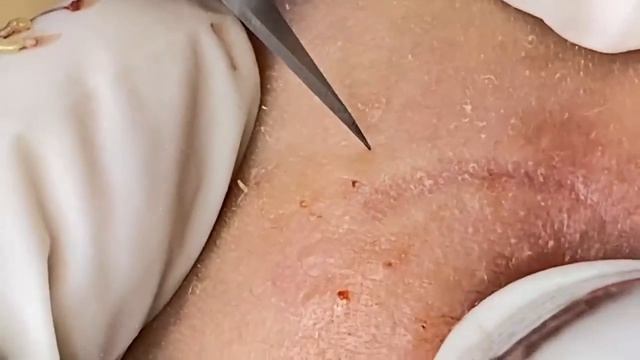 Выдавливание прыщей, угрей, черных точек и камедонов #374