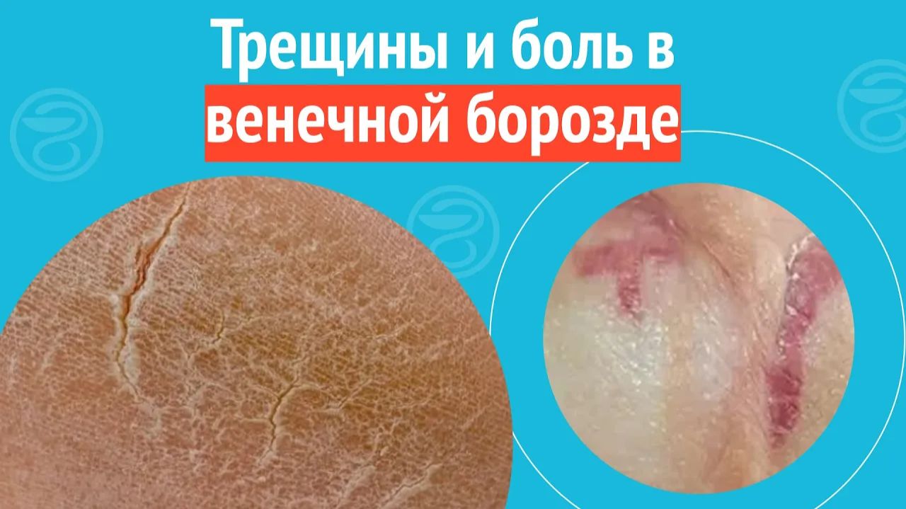 😦 Трещины и боль в венечной борозде. Клинический случай №1270