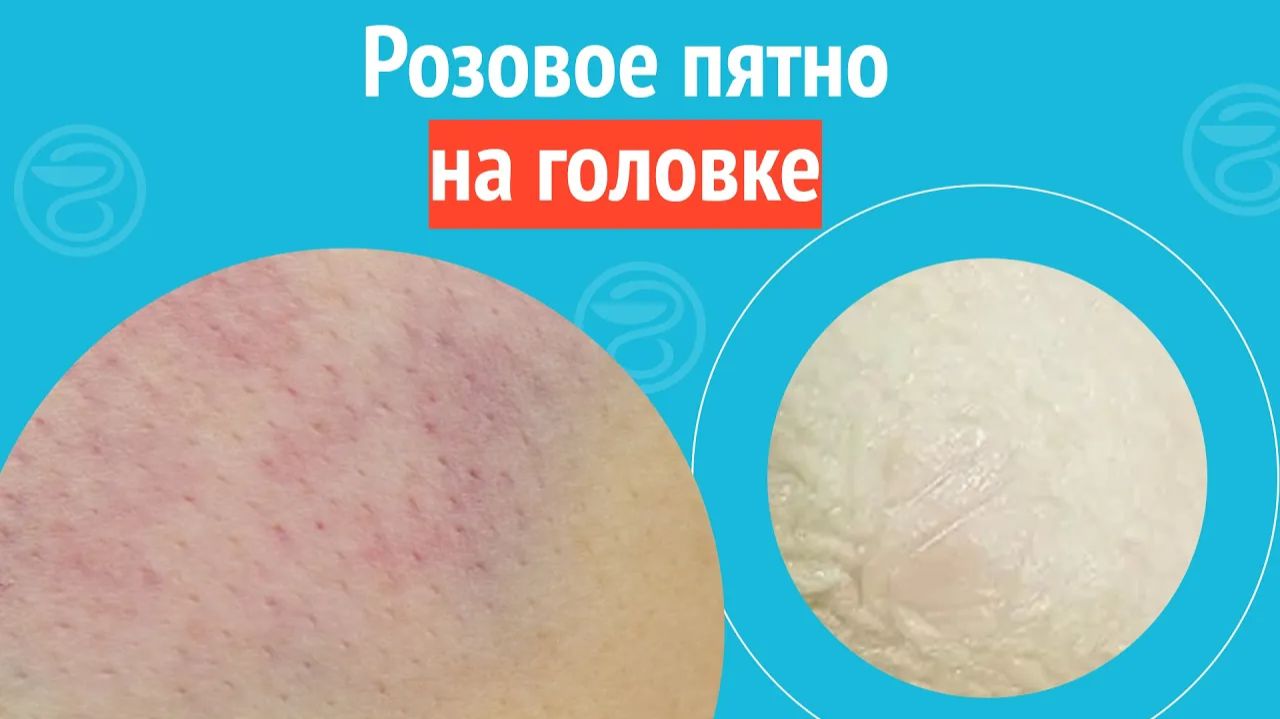 ⏸️ Розовое пятно на головке. Клинический случай №1273