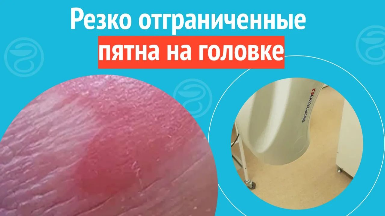 👉 Резко отграниченные пятна на головке. Клинический случай №1274