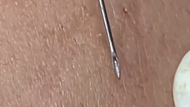 #278 Чистка лица от угрей и акне. Выдавливание прыщей. Удаление черных точек и комедонов