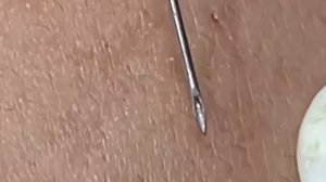 #278 Чистка лица от угрей и акне. Выдавливание прыщей. Удаление черных точек и комедонов