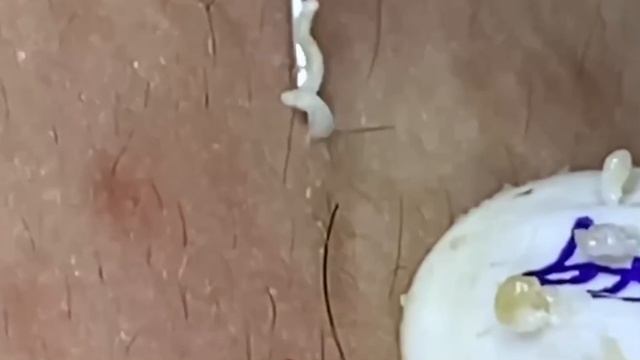 #277 Чистка лица от угрей и акне. Выдавливание прыщей. Удаление черных точек и комедонов