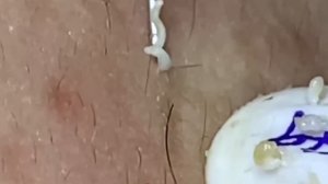 #277 Чистка лица от угрей и акне. Выдавливание прыщей. Удаление черных точек и комедонов