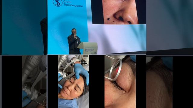 Гамидов Айнутдин. Протокол максимального сокращения кожного лосткута. Лазерная блефаропластика.