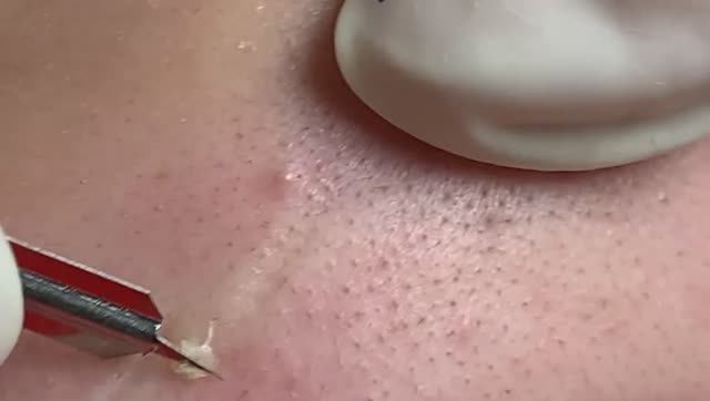 Удаление угрей. Профессиональное очищение кожи