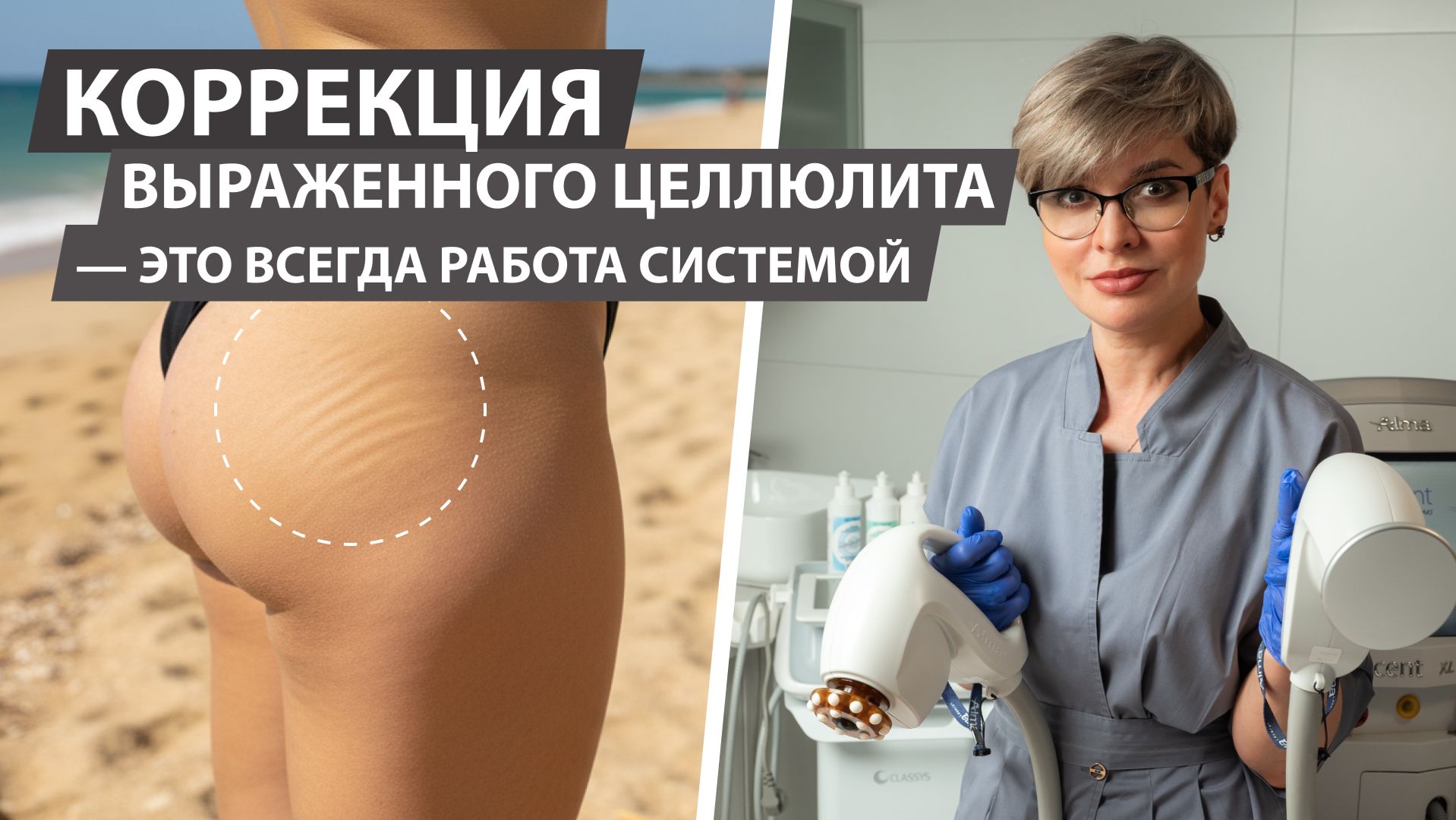 Коррекция выраженного целлюлита — это всегда работа системой.
