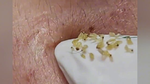 Выдавливание прыщей, угрей, черных точек и камедонов #376