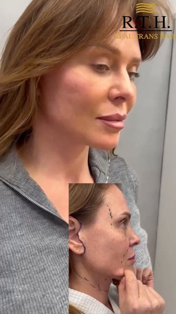 Результат после подтяжки лича, через 2 гедели