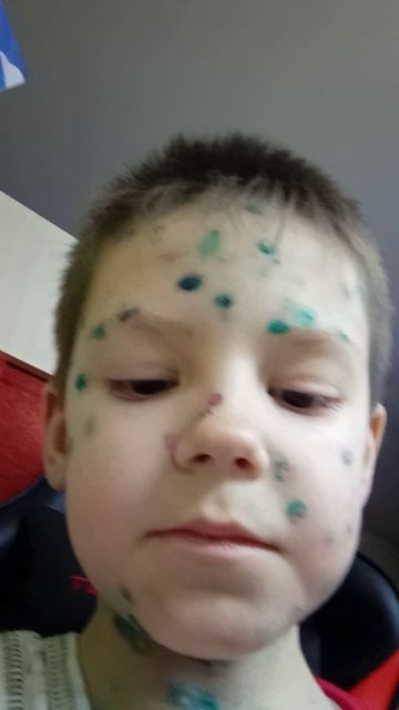 заболел ветрянкой