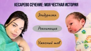Мои роды.Часть 2. Кесарево сечение
