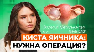 Киста яичника: симптомы и когда без операции не обойтись