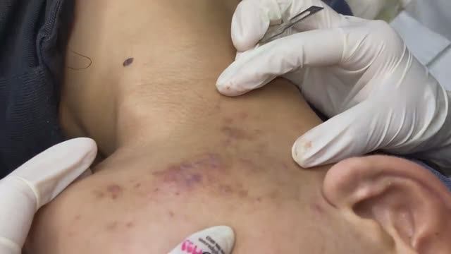 090 • Acne collection • АСМР • Relax Spa