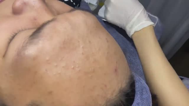 092 • Acne Collection • АСМР • Relax Spa