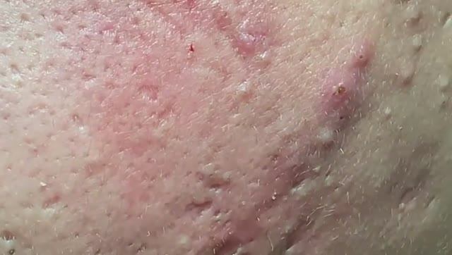 Огромные прыщи по всему лицу — лечение акне.