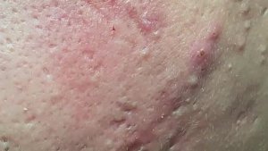 Огромные прыщи по всему лицу — лечение акне.