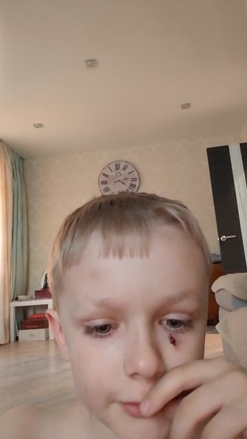 МНЕ РАЗБИЛИ ЧУТЬ НЕ РАЗБИЛИ ГЛАЗ ПАЛКОЙ