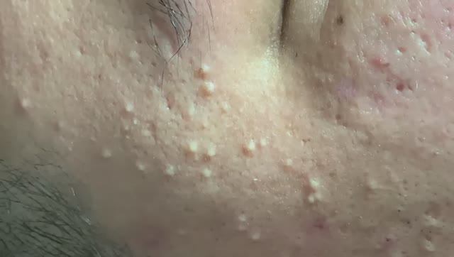 Огромные прыщи по всему лицу — лечение акне.