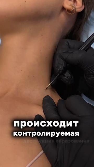 Удаление родинок электроволновым методом