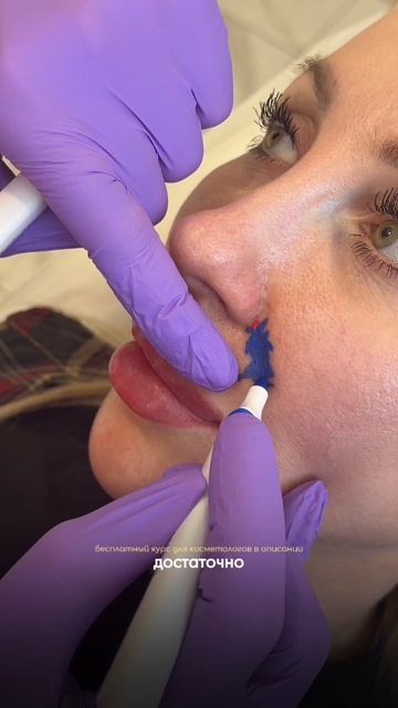 Убираем носогубные складки