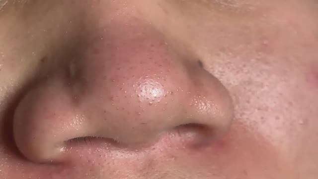 Выдавливание прыщей, от которого невозможно оторваться