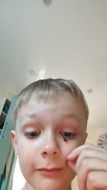 КАК МНЕ ЧУТЬ НЕ РАЗБИЛИ ГЛАЗ А ТО МНЕ БЫ ПРИШЛОСЬ В ТРАНТПУНК