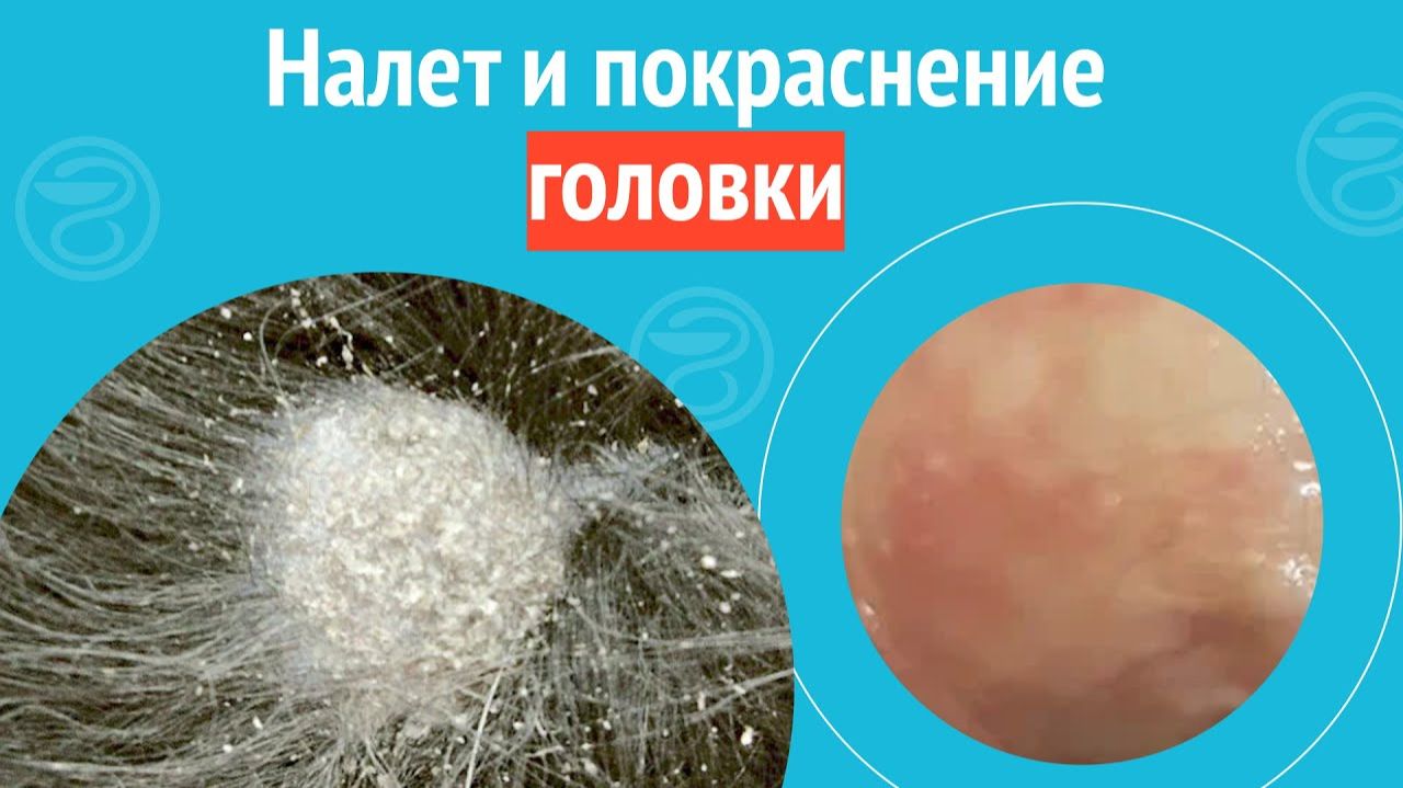 😲 Налет и покраснение головки. Клинический случай №1276