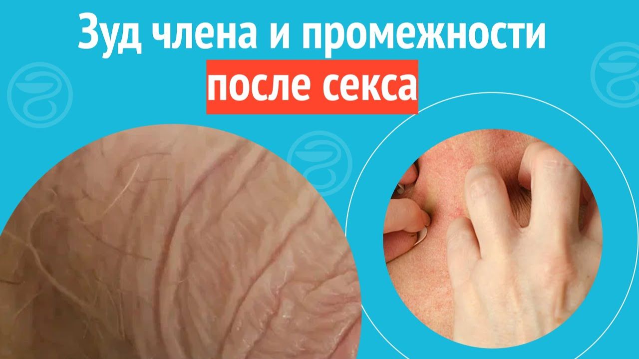 ➡️ Зуд члена и промежности после секса. Клинический случай №1269