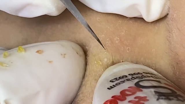 Выдавливание прыщей, угрей, черных точек и камедонов #375