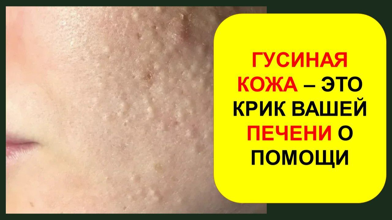 Гусиная кожа - это КРИК вашей ПЕЧЕНИ о ПОМОЩИ!