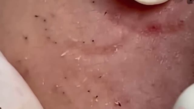 #281 Чистка лица от угрей и акне. Выдавливание прыщей. Удаление черных точек и комедонов