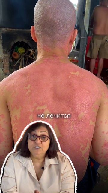 Псориаз передаётся по наследству? Вся правда о генетике за 60 секунд. Лекция в шапке 👆