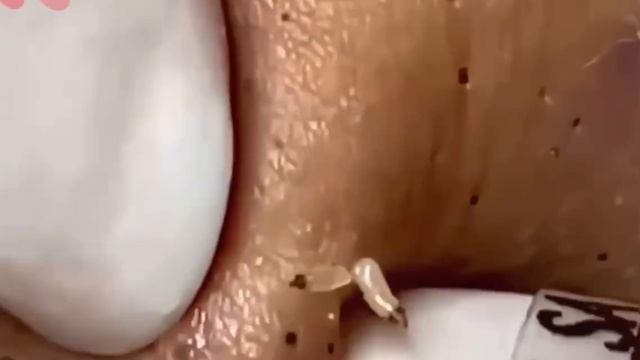 #280 Чистка лица от угрей и акне. Выдавливание прыщей. Удаление черных точек и комедонов