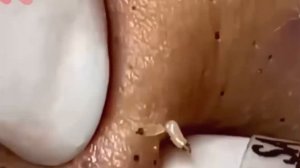 #280 Чистка лица от угрей и акне. Выдавливание прыщей. Удаление черных точек и комедонов