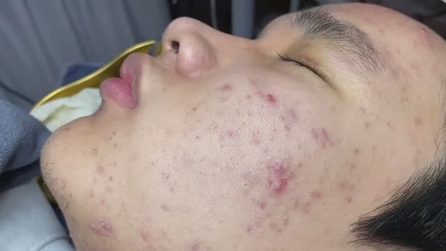 ВАУ! Столько черных и белых точек вы еще не видели — чистка лица