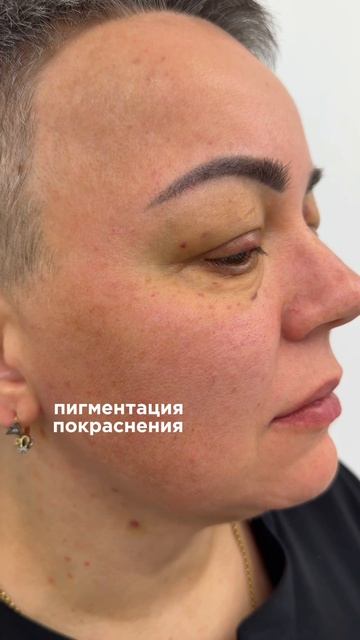 IPL и BBL — популярные технологии световой терапии для кожи.✨