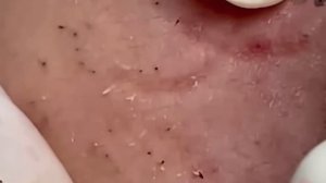 #281 Чистка лица от угрей и акне. Выдавливание прыщей. Удаление черных точек и комедонов