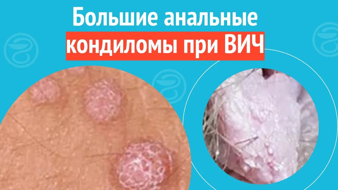 😨 Большие анальные кондиломы при ВИЧ. Клинический случай №1268