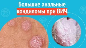😨 Большие анальные кондиломы при ВИЧ. Клинический случай №1268