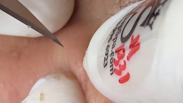 Выдавливание прыщей, угрей, черных точек и камедонов #379