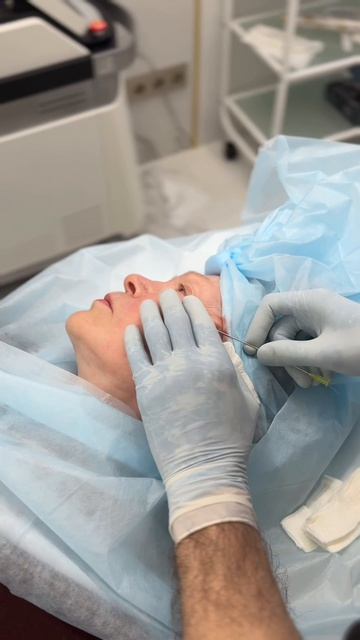 Результат от процедуры нитевого лифтинга 😍