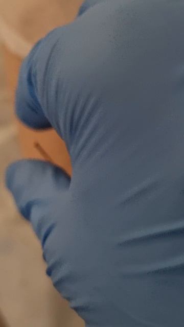 классическая китайская корпоральная акупунктура в лечении нервных болезней